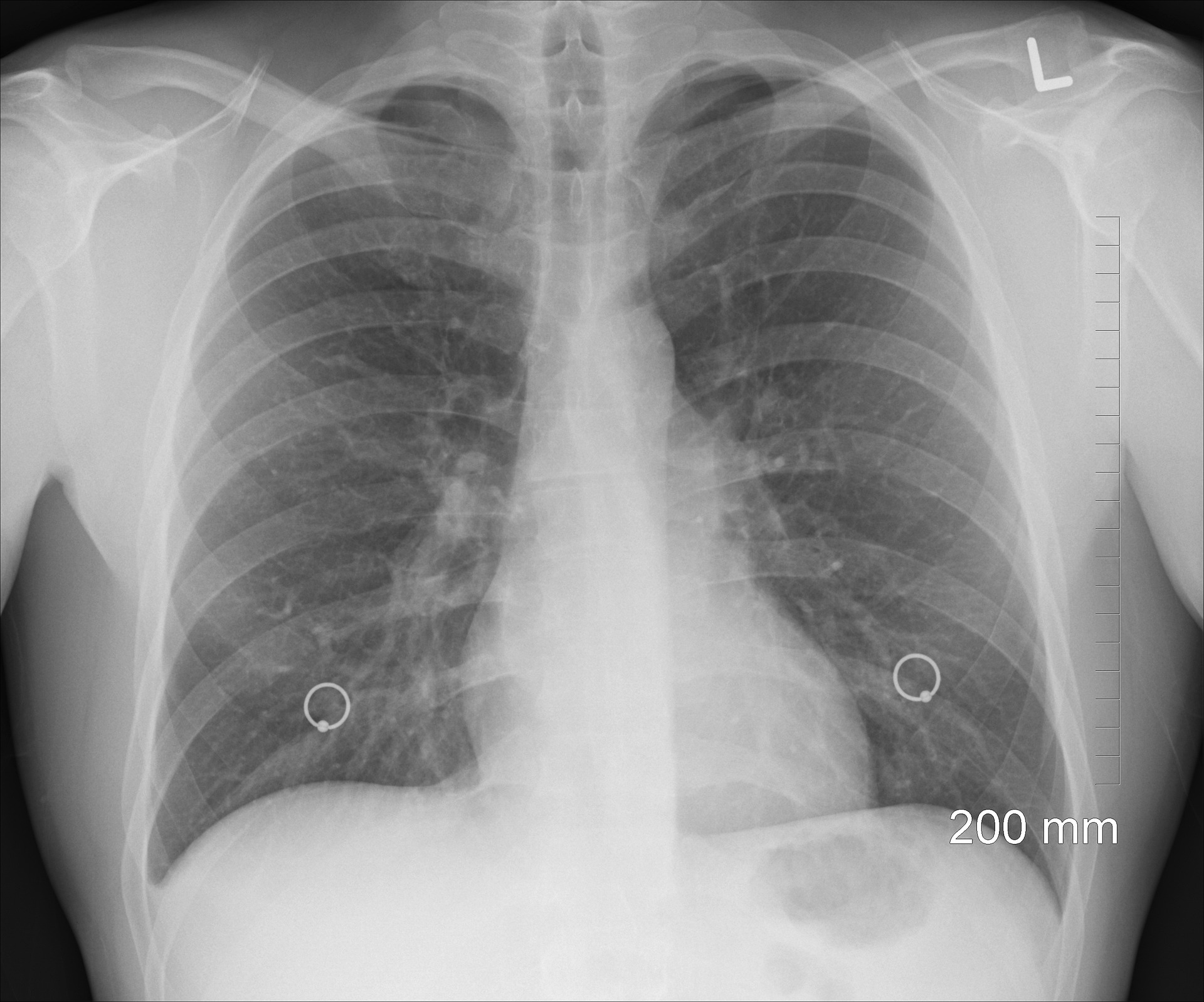 Air Pollution and Lung Cancer